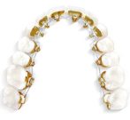 裏側矯正の器具の写真